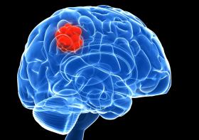 Image - Discovery of biomarker offers hope for brain cancer patients